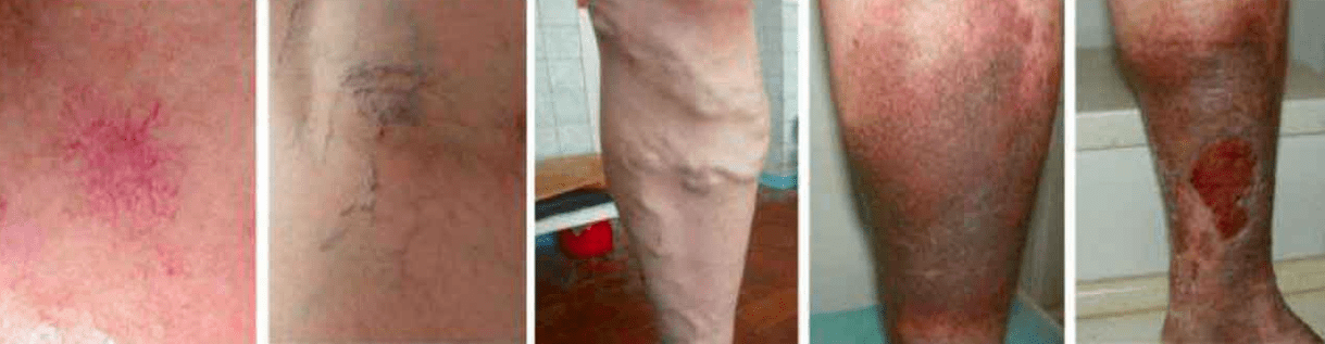 Στάδια κινεζικών φλεβών στα πόδια