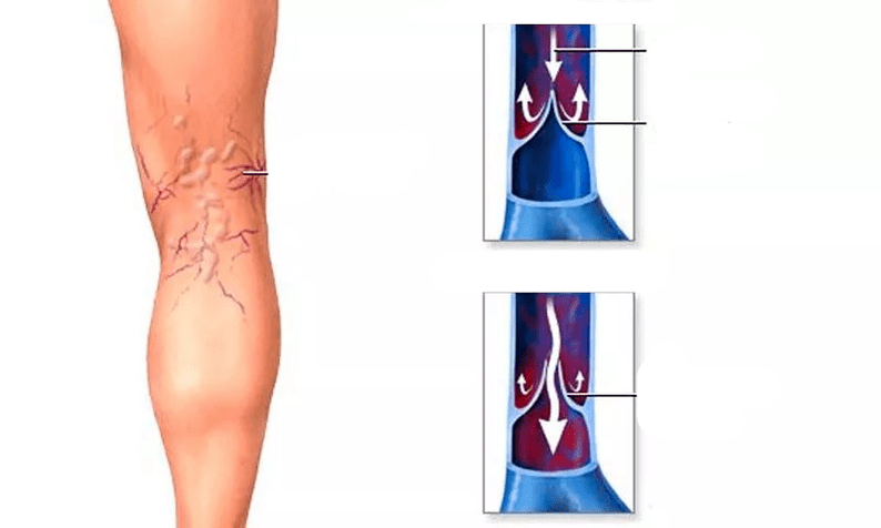 Μετακίνηση αίματος